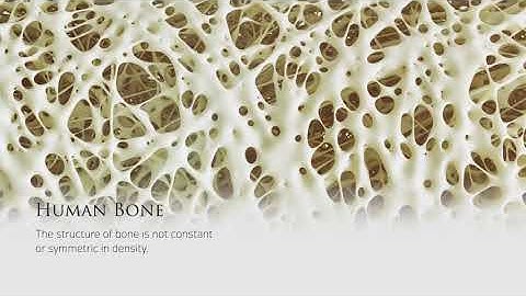 3D Printing For Treating Fractures and Lost Bone