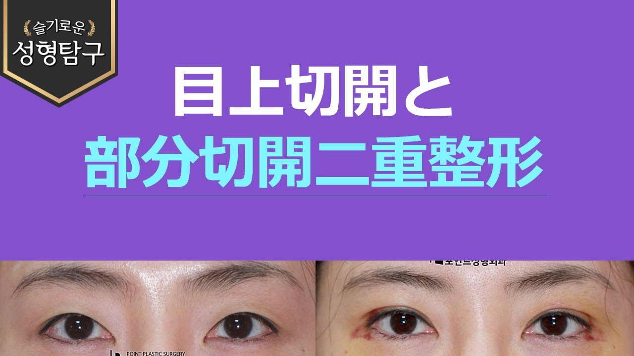 【韓国二重整形】目上切開と部分切開二重整形1週間目