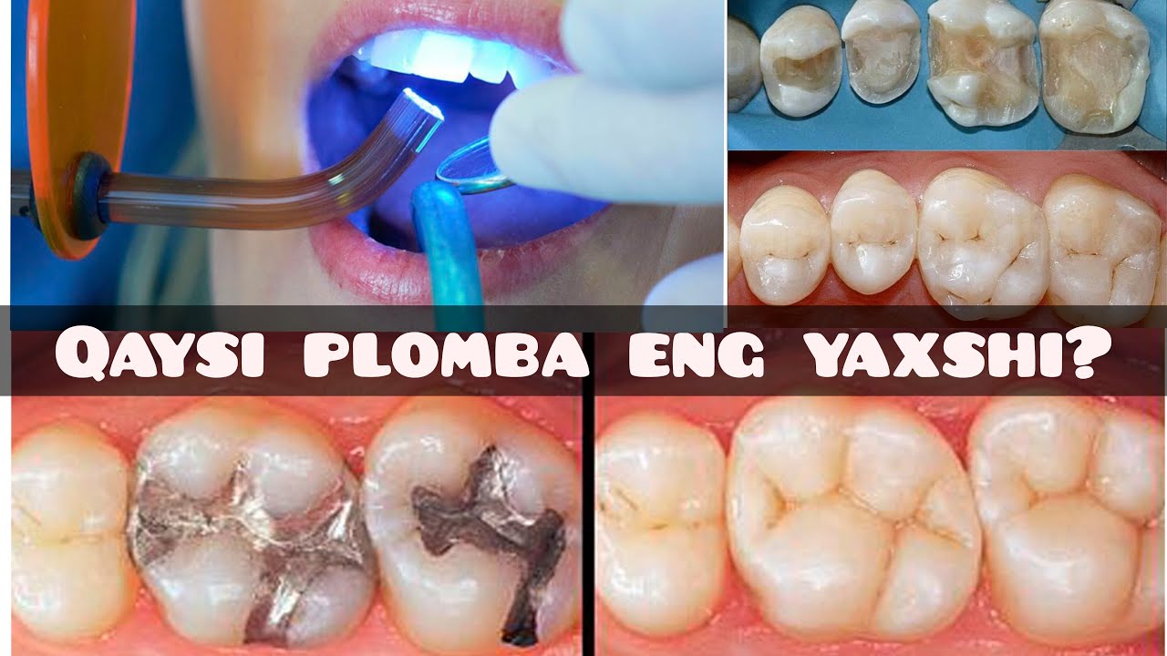 QAYSI PLOMBA ENG YAXSHI?  КАЙСИ ПЛОМБА ЭНГ ЯХШИ?