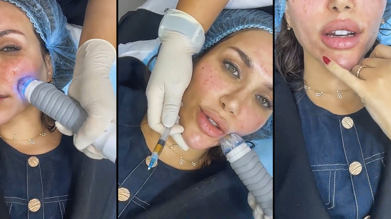 دكتوره خلود تسوي  فيفاتشي وهيدرا فيشل وديرما  قبل تسافر الرياض 💙