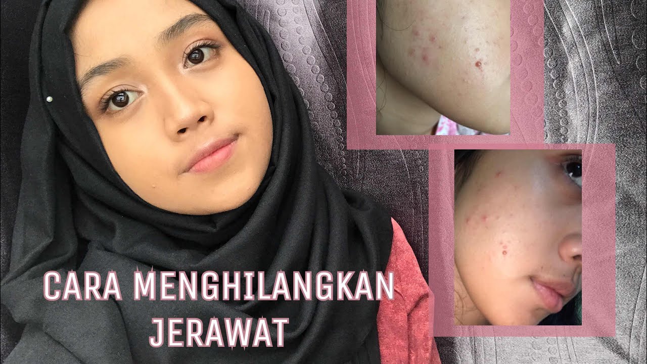 Menghilangkan Jerawat Dengan Mudah || itszifa