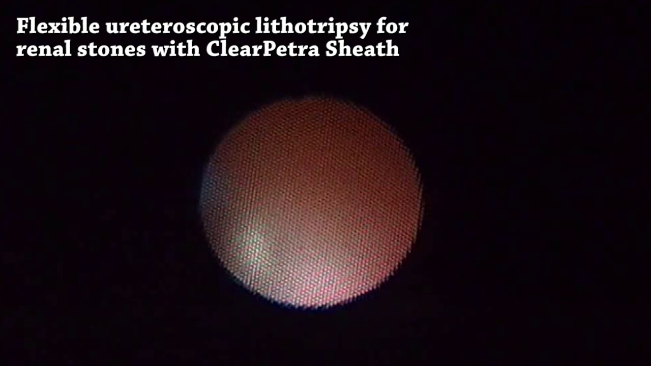 Flexible Ureteroscopic Lithotripsy for Renal Stones with ClearPetra ...