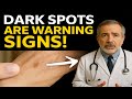 The Hidden Meaning Behind Dark Spots — It’s Not Just Aging!