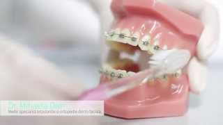 Cum ne periem pe dinti cu aparatul dentar fix (bracketi) ? ORTO-IMPLANT