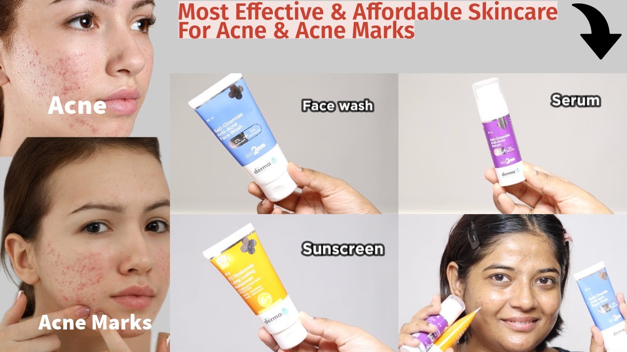 Affordable Skin Care Routine For Acne & Acne Marks | Get Clear ...