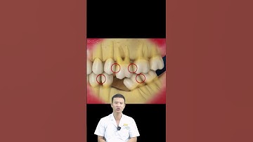 Điều Gì Xảy Ra Khi Mất Răng | Bác Sĩ Yên