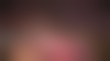 Lap wedge fundal GIST