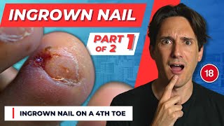 INGROWN TOENAIL of a 4th Toe part 1 of 2