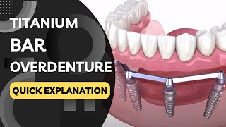 What is a Titanium Bar Overdenture? Quickly Explained in a Few Seconds!