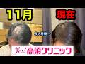 【3ヶ月で爆発増毛】高須クリニックの増毛アンバサダーとしてしっかりと結果を残した現実