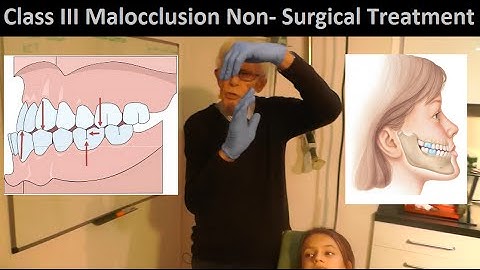 Correcting Class III Malocclusion without Tooth Extraction or Oral Surgery by Prof John Mew