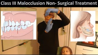 Correcting Class III Malocclusion without Tooth Extraction or Oral Surgery by Prof John Mew