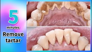 【tooth cleaner】🤩How to remove tartar and whiten teeth in 5 minutes?