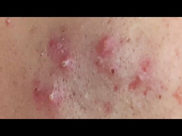 Acne Treatment Huong Da Nang | 2023 | Thanks