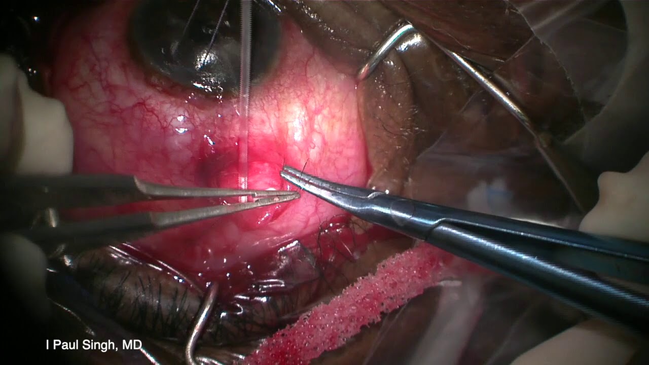 ClearPath Glaucoma Drainage Device Small Incision Surgery - Paul Singh