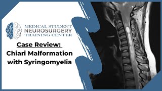 Case Review: Chiari Malformation with Syringomyelia