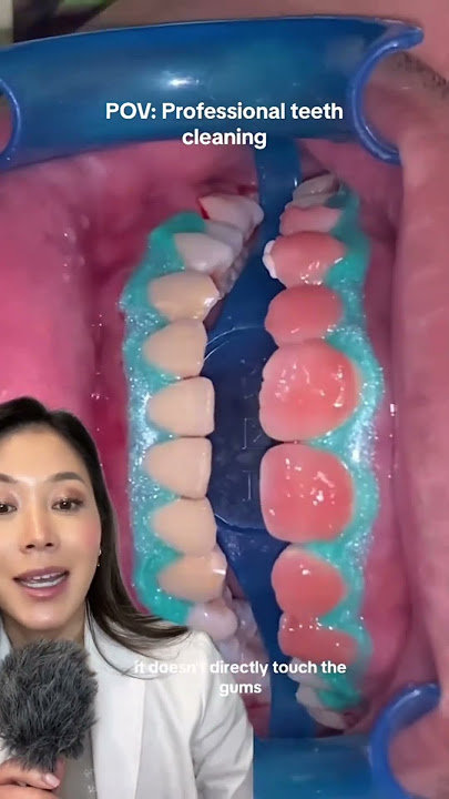 Professional teeth whitening from start to finish. #teethwhitening #whiteteeth #dentist