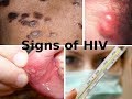 Symptoms and signs of HIV infection