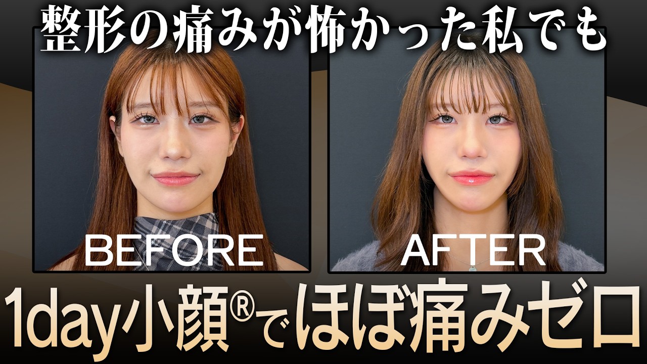誰にもバレずに頬のコケと二重アゴを改善！ほぼ痛みゼロ の「1day小顔®︎」の経過に密着！
