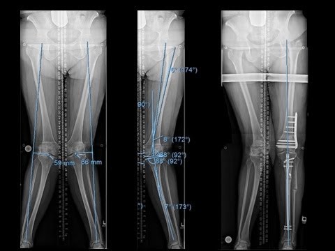 Video: Varus Knee: Příznaky, Příčiny, Chirurgie A Léčba