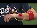 Mlb worst and brutal hit by pitch