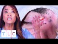 "It Could Push My Eye Out Of The Socket": A Dangerous Eye Cyst | Dr. Pimple Popper