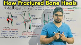 Fracture Healing Process: Repair of Fractured Bone screenshot 4