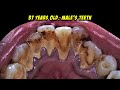 Teeth Cleaning | Tartar | Scaling | Dentist | Dokter Gigi Tri Putra