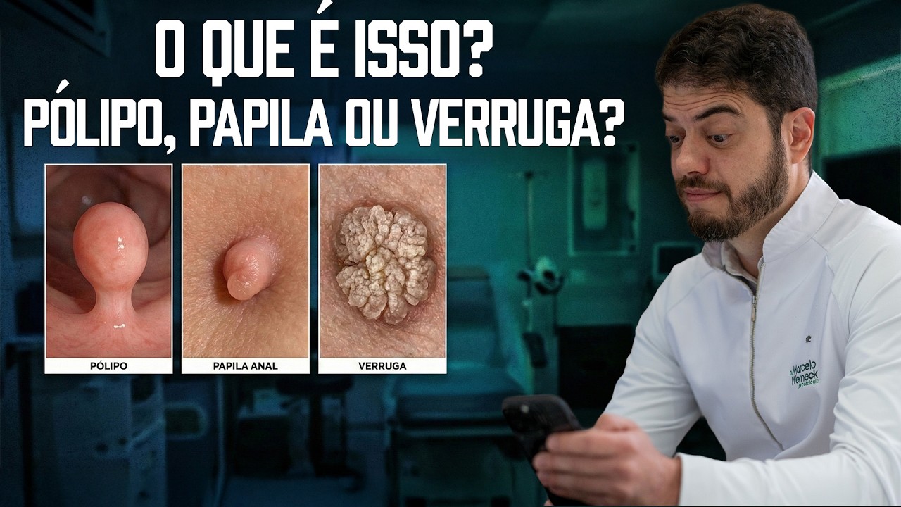 Pólipo, Papila Anal ou Verruga? Entenda as Diferenças e Quando se Preocupar