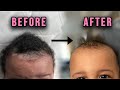 GET RID OF BABY ECZEMA AND CRADLE CAP IN DAYS ! | ALL PARENTS MUST WATCH