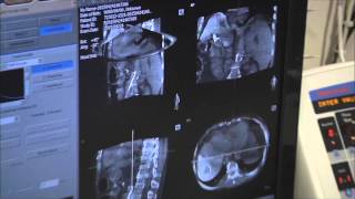 Drug-Eluting Bead Chemoembolization (DEB-TACE) for Liver Cancer