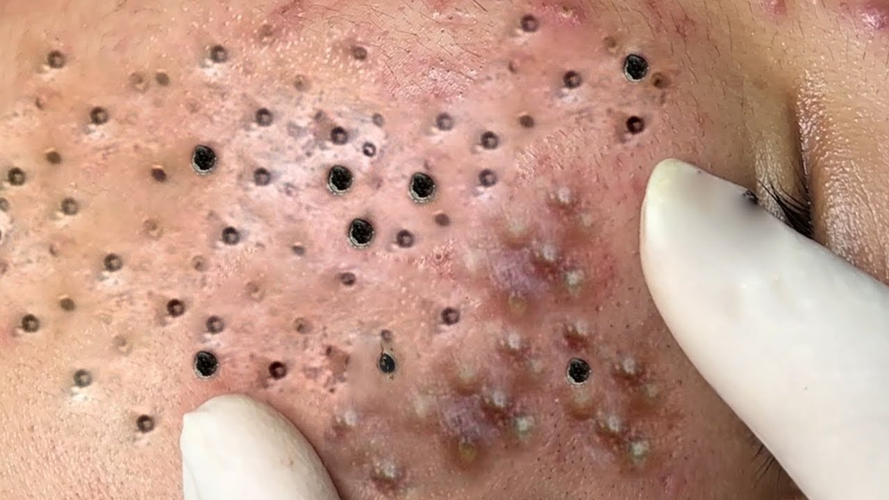 🔴LIVE Blackhead Extraction Removal 49 YouTube
