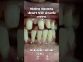 #smiledesigndentistry #zirconiacrowns#dentalcrownprocedure #dentalclinic #dentalprocedure