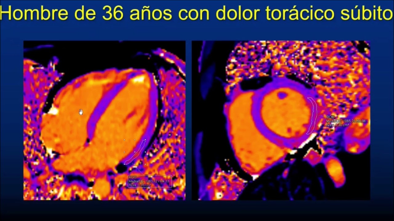 Caso Clínico 68: Miocarditis aguda.