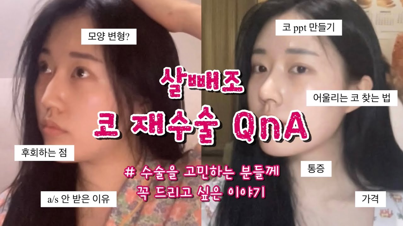 [코재수술QnA] 부작용 온 이유? 병원 잘 고르는 꿀팁?👃🏻 떡볶이 먹으면서 코수술에 관한 모든 것들을 알려드립니다🤓