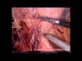 Minimally Invasive D2 LN dissection in radical gastrectomy for gastric cancer - A video tutorial