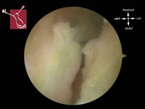 Standard 2- Portal Hindfoot Approach