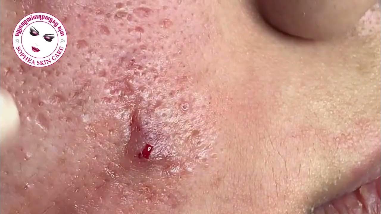 acne removal facial treatment by sopheaskincarecambodia clinic 08 March