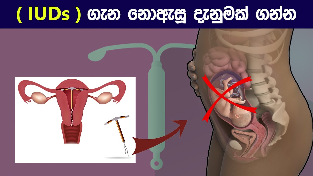 උපත් පාලනයට ( IUDs )😨 | How intrauterine devices ( loop ) works to ...