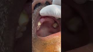 Removable denture #scaling shortsvideo #drvibhavaridental #shortsviral