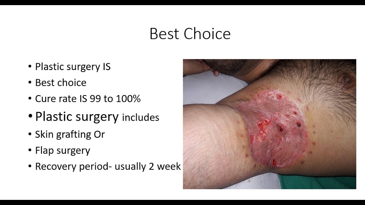 Hidradenitis Suppurativa Acne Inversa Apocrinitis Armpit Boil