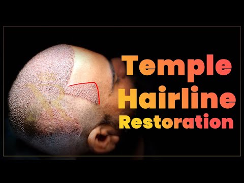 Temple Hair Restoration Explained: Enhancing Your Hairline 🧐 | New Roots Hair Transplant