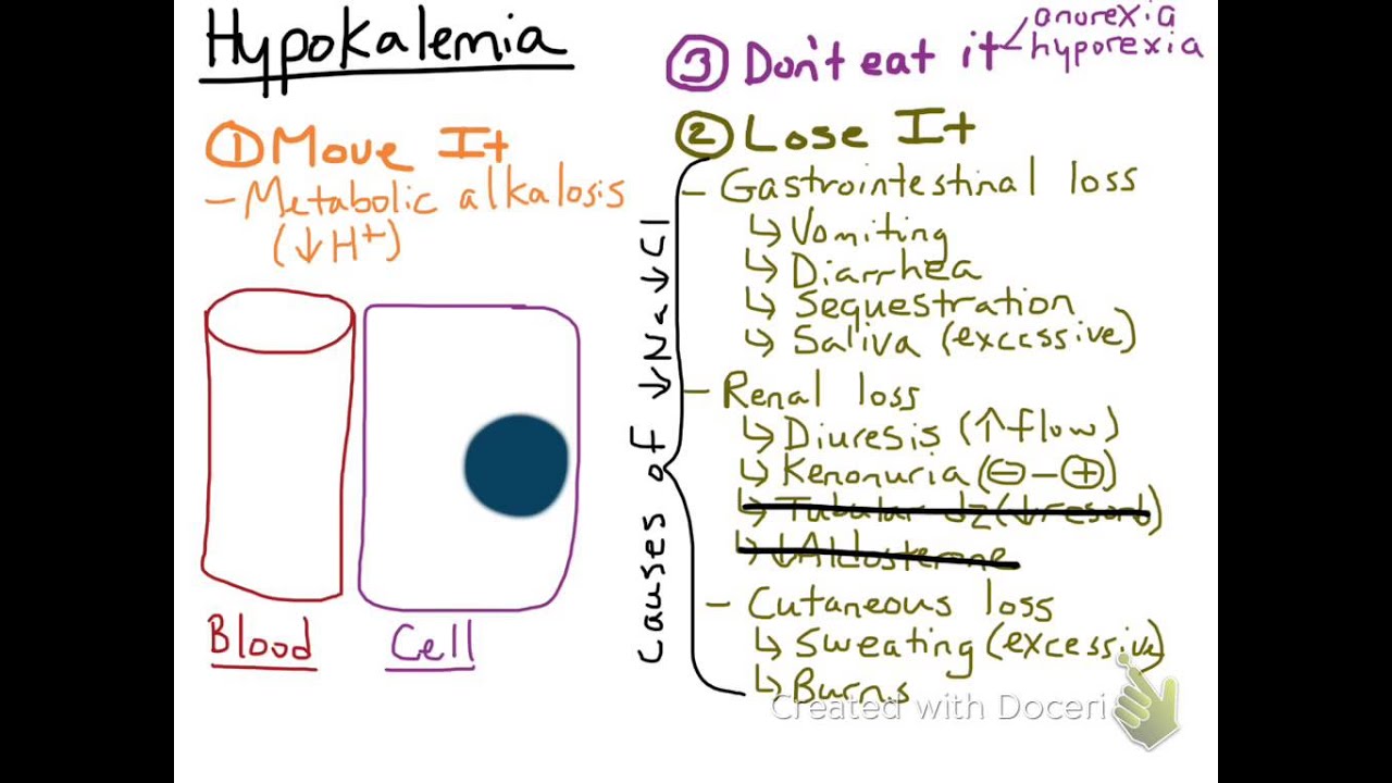 Hypokalemia Hypokalemia
