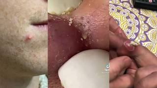 Pimple Popping - Ultimate Pimple Popping Compilation#142