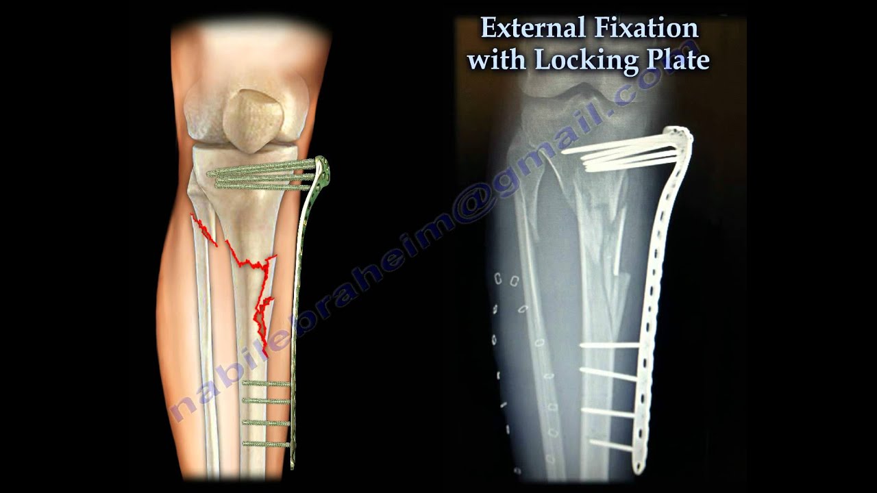 External Fixation With Locking Plate - Everything You Need To Know - Dr. Nabil Ebraheim