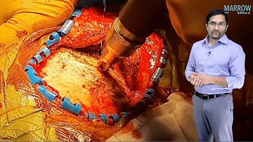 E6 Sample Video: Epidural & Subdural Hematoma (Surgery)