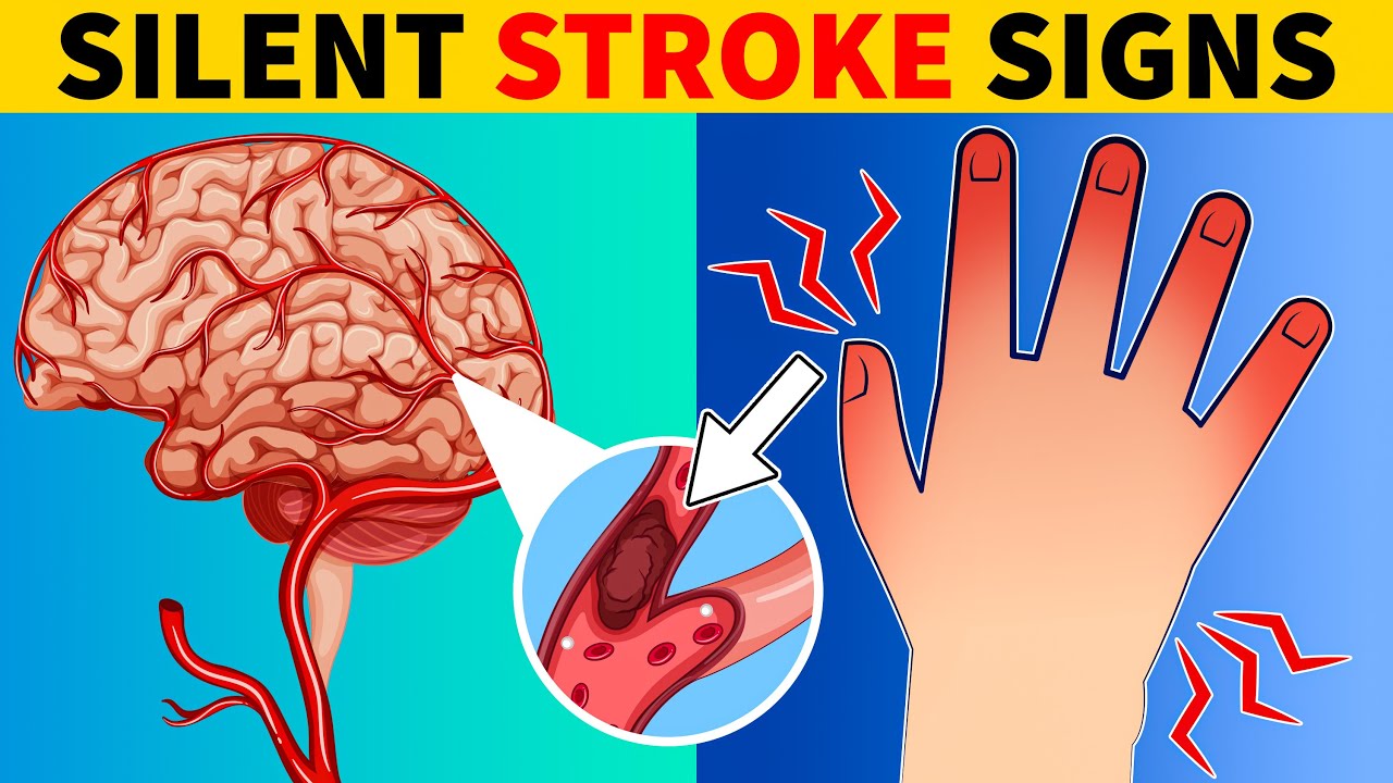 8 Silent Stroke Signs You Should Never Ignore | JoyHealth