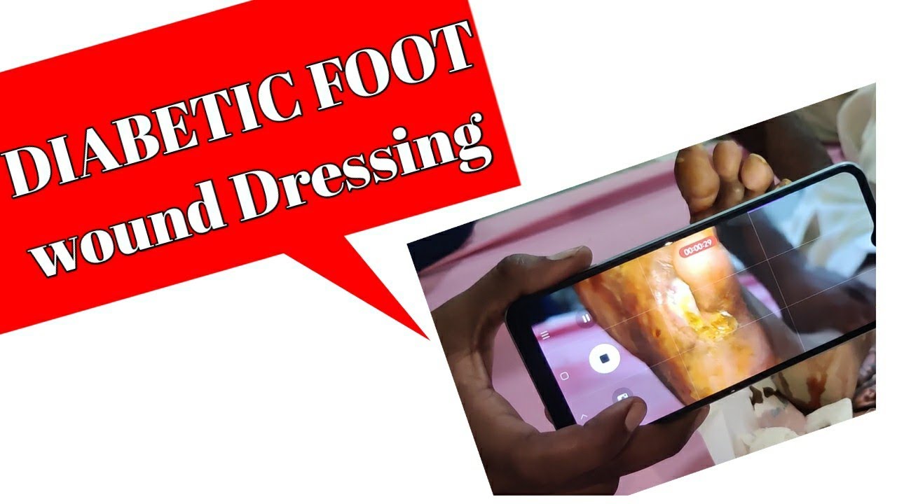 Diabetic foot l Diabetic foot Dressing l Diabetic foot care । foot
