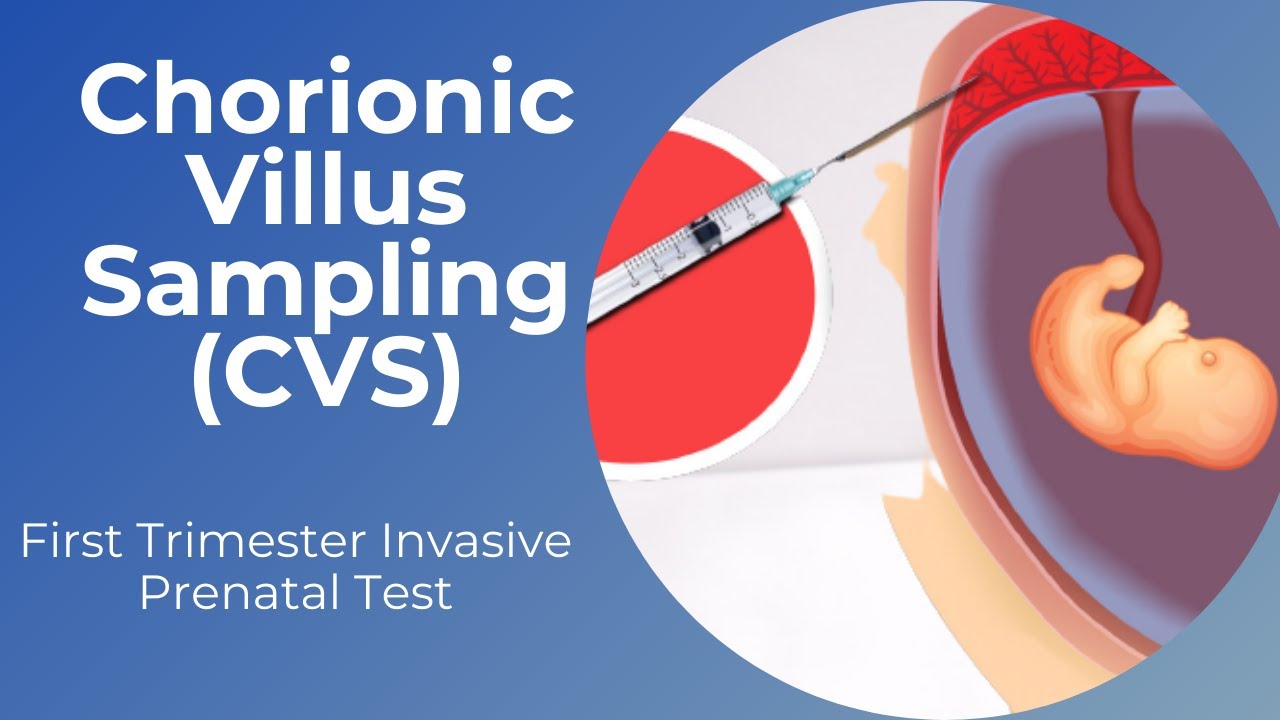 Chorionic Villus Sampling (CVS) | First Trimester Prenatal Diagnosis ...