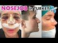 MY RHINOPLASTY (NOSE JOB) EXPERIENCE IN TURKEY!! ✈️  Everything you need to know! (Part 1)